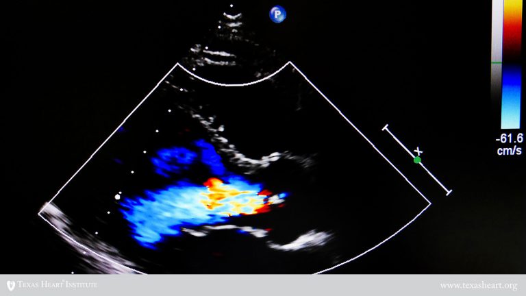 echocardiography