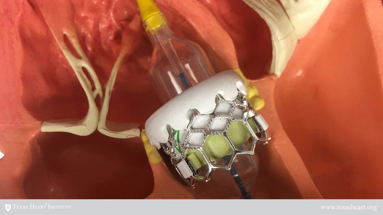 Heart Valve Repair or Replacement | The Texas Heart Institute®