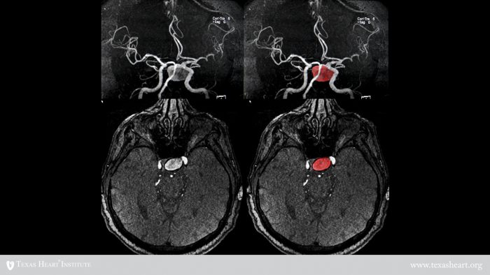 Aneurysm Repair | The Texas Heart Institute