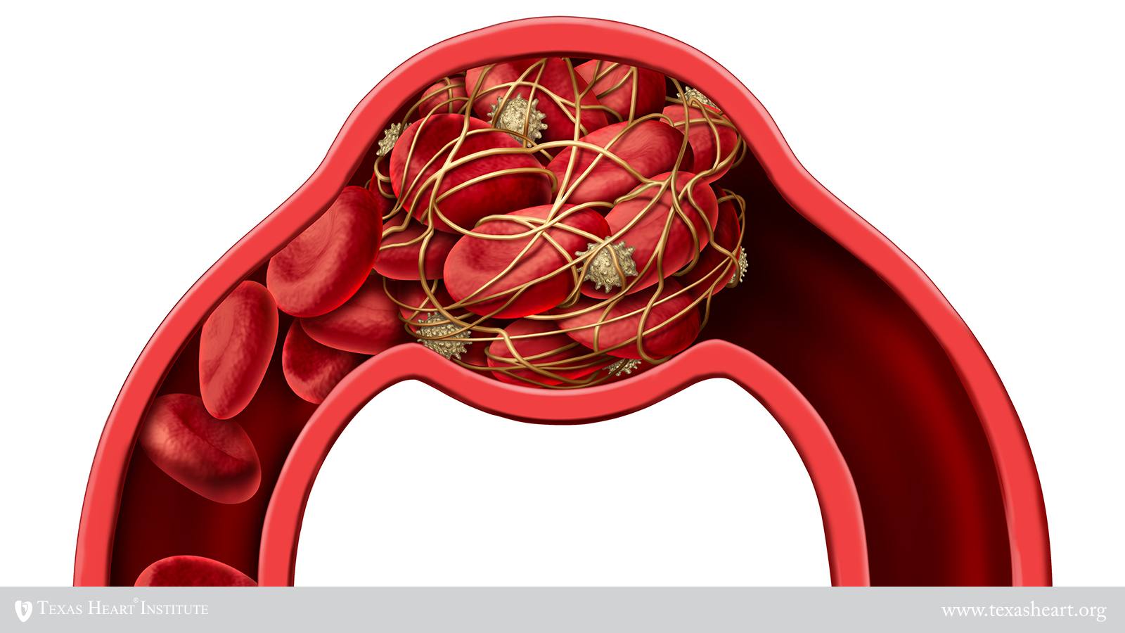 Venous Blood Clots including DVT Texas Heart Institute