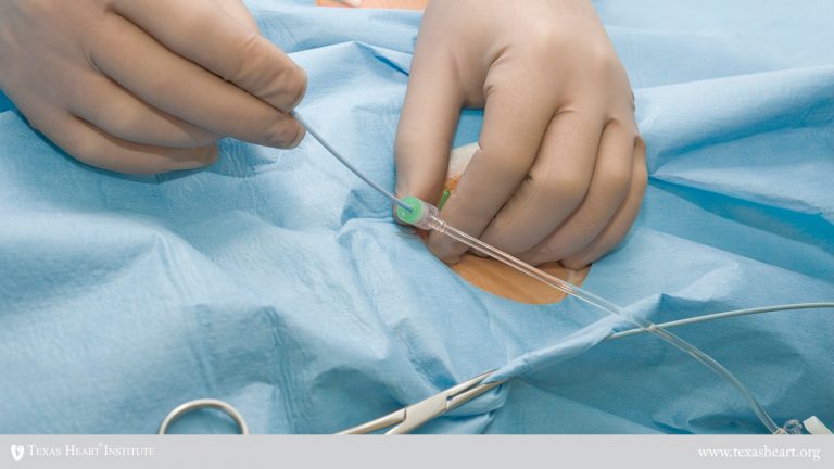 Catheter Ablation | The Texas Heart Institute®