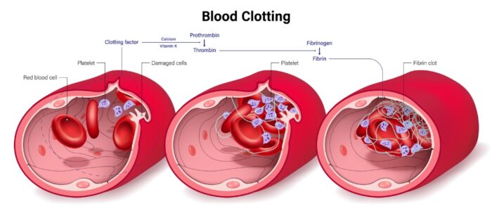 Hypercoagulable States | The Texas Heart Institute®